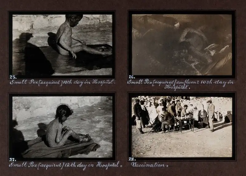 巴勒斯坦天花流行中的患儿