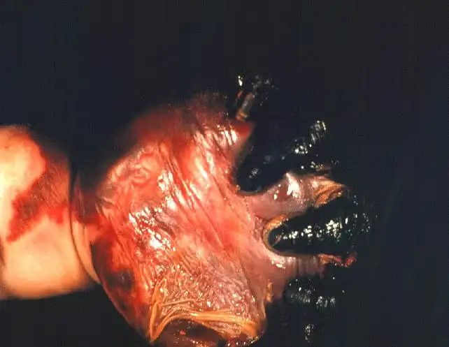 脑膜炎球菌血症导致的严重皮肤坏死