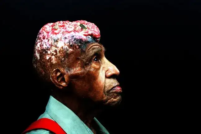 头癣受害者Vertus Hardiman的头部伤口，他终身用假发遮盖这个辐射造成的永久性创伤。1927年，年仅五岁的他与另外九名黑人儿童在印第安纳州被进行辐射实验。来源：Smith Leonard Productions