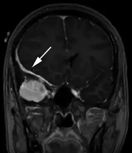 伴有"硬膜尾征"的脑膜瘤MRI影像。硬膜尾征是脑膜瘤的特征性表现之一。来源：PMC
