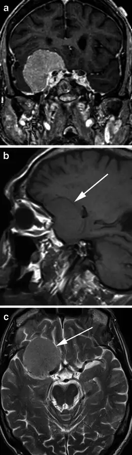 脑膜瘤的MRI影像。儿童时期接受头癣放射治疗的人群，其脑膜瘤发病率是普通人群的四倍以上。来源：PMC