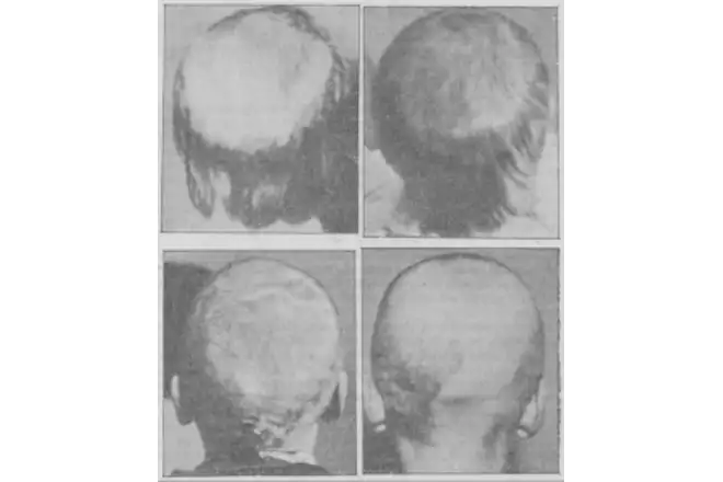 20世纪初因头癣接受放射治疗导致头发完全脱落的儿童。来源：J.M.H. MacLeod