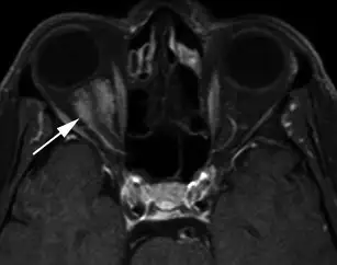 眶内脑膜瘤的MRI影像，肿瘤包裹视神经。辐射是脑膜瘤的已知风险因素之一。来源：PMC