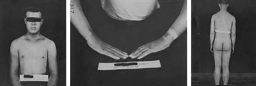 海军研究实验室的历史图像描绘了一名暴露于芥子气的测试对象的结果。