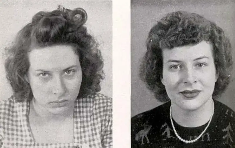 Before and After Lobotomy Photos