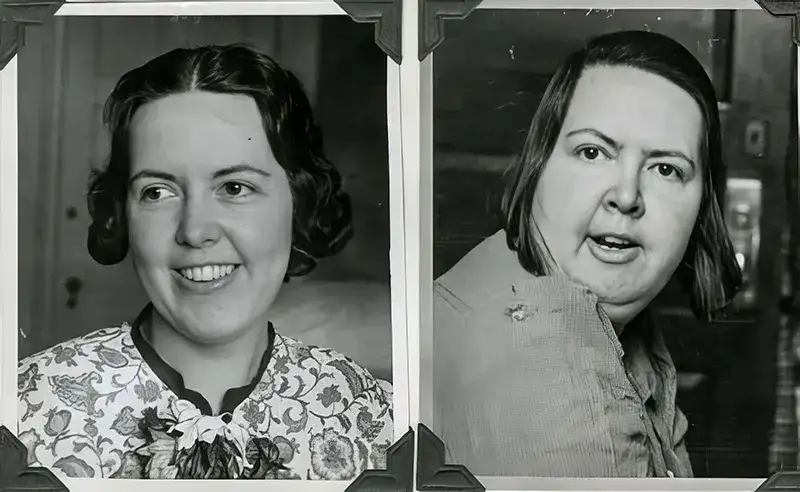 Before and After Lobotomy Photos