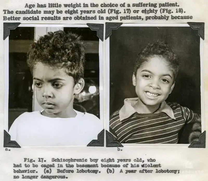 A before and after shot of a little boy that underwent a lobotomy