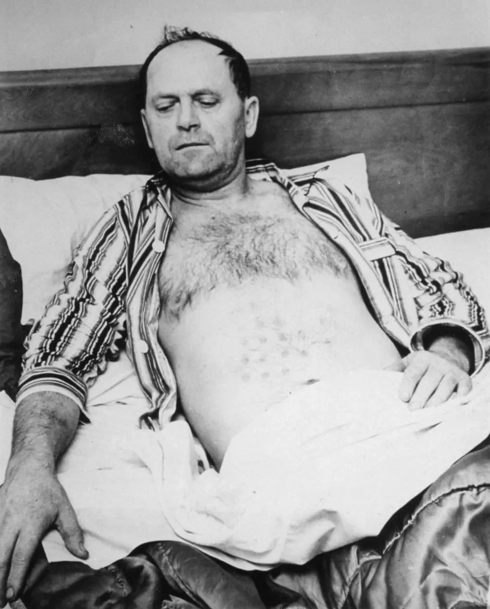 Stefan Michalak在床上展示腹部烧伤