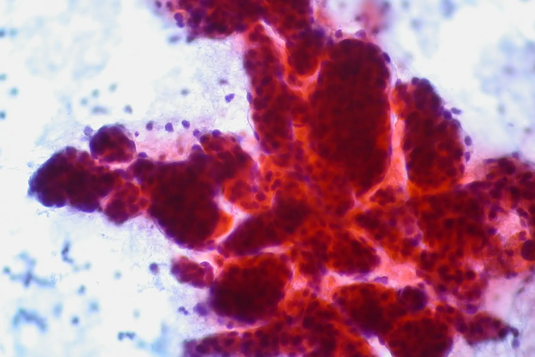 肝细胞癌的病理切片显微镜图像