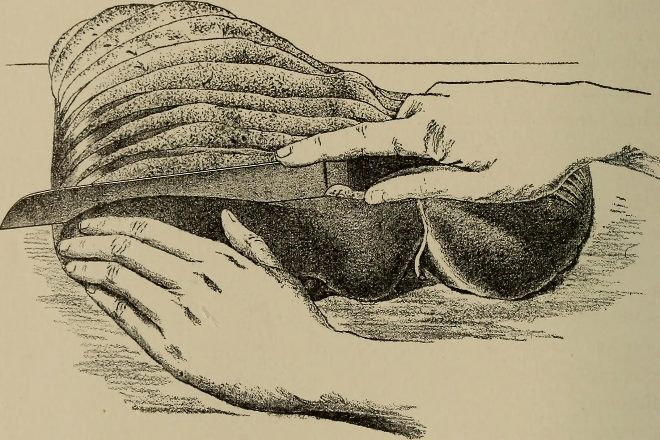 古代病理学文献中记录的肝脏病变图像