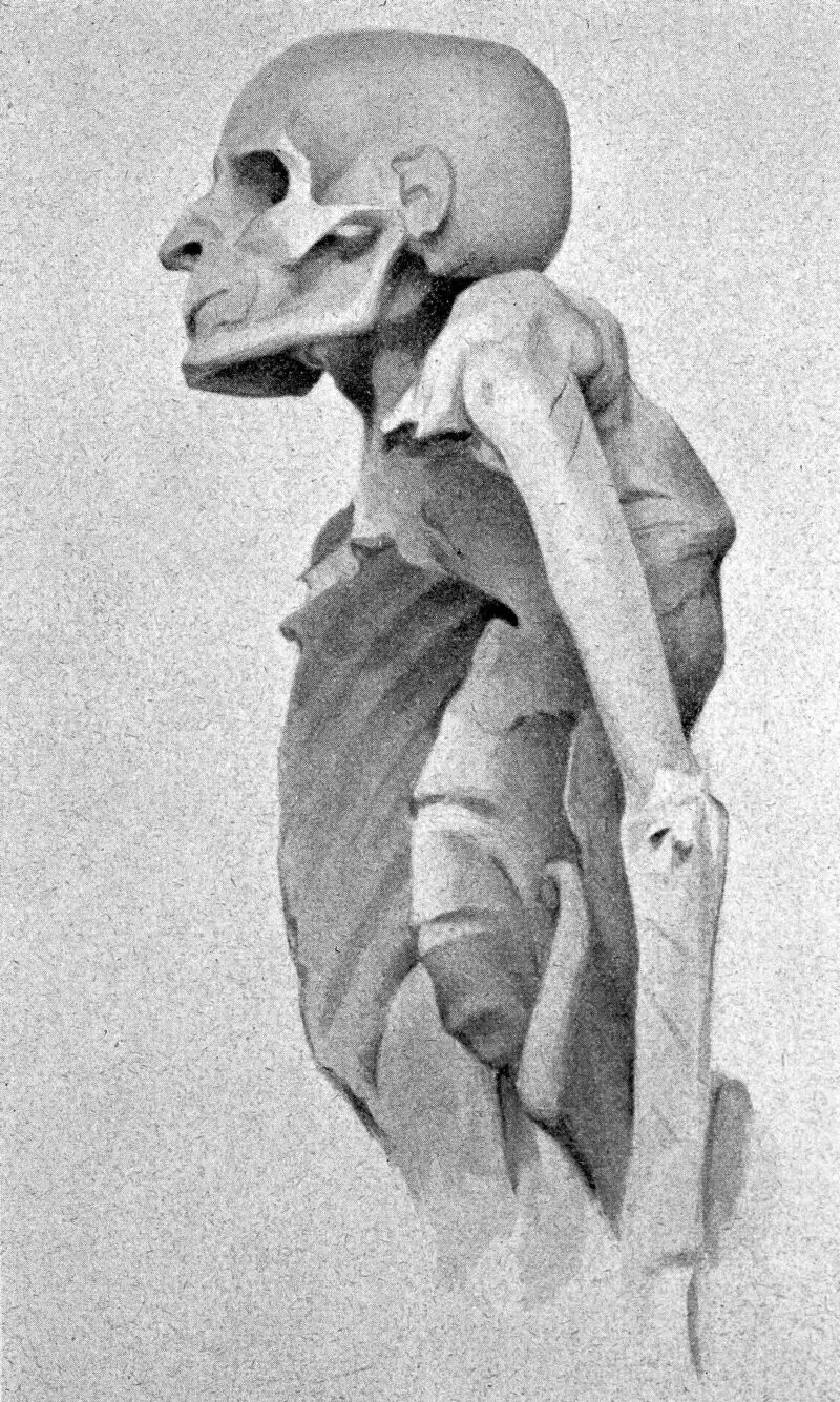 Pott病:古埃及木乃伊中的脊柱结核证据