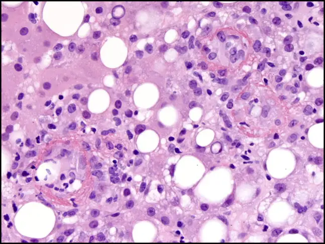 Q热肝炎患者的肝活检显示典型的纤维环肉芽肿
