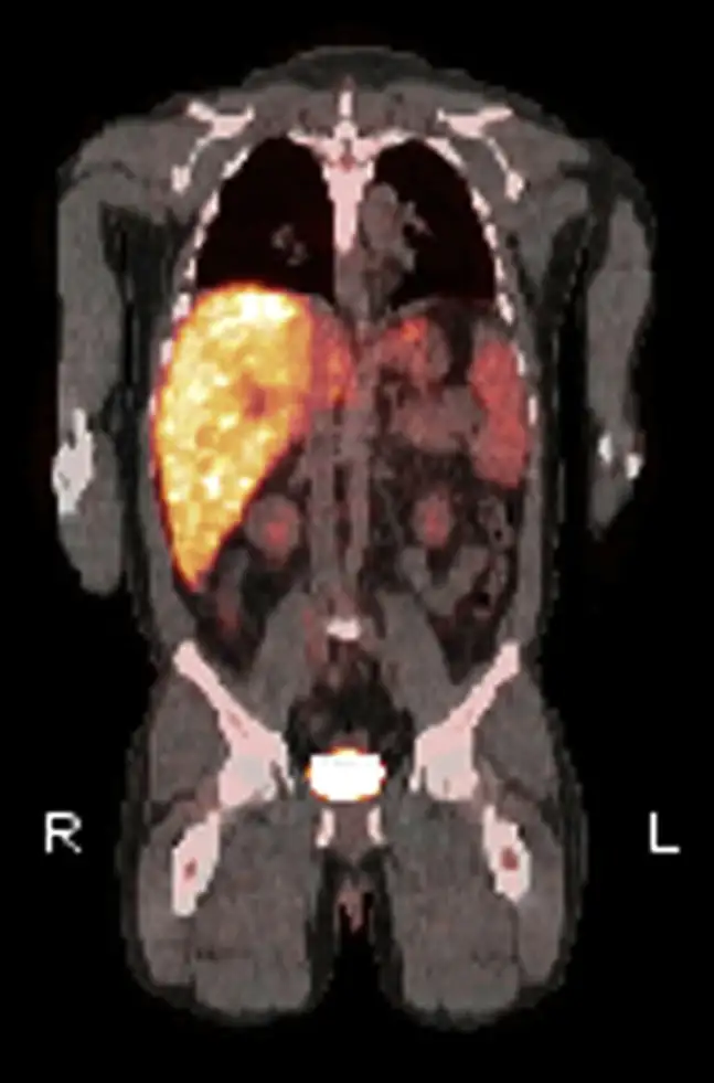 Q热患者的PET扫描显示肝脏弥漫性炎症