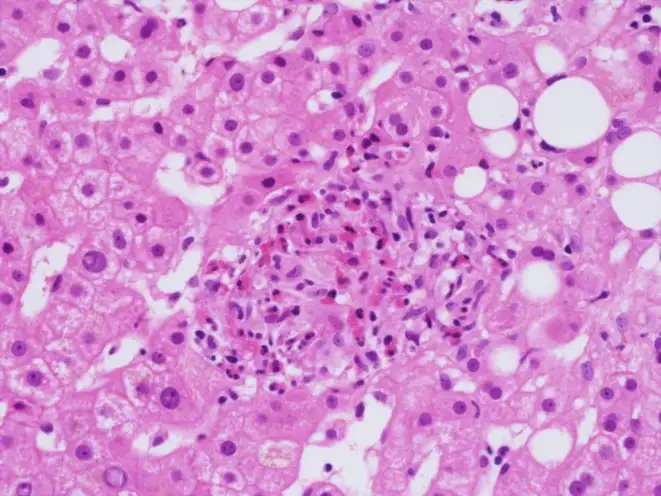 Q热肝炎患者的肝活检显示纤维环肉芽肿的组织学特征