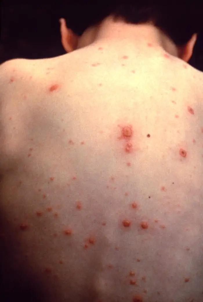 Varicella Rash on Body
