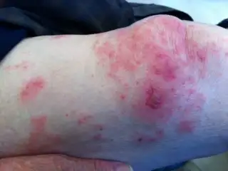 Shingles Rash