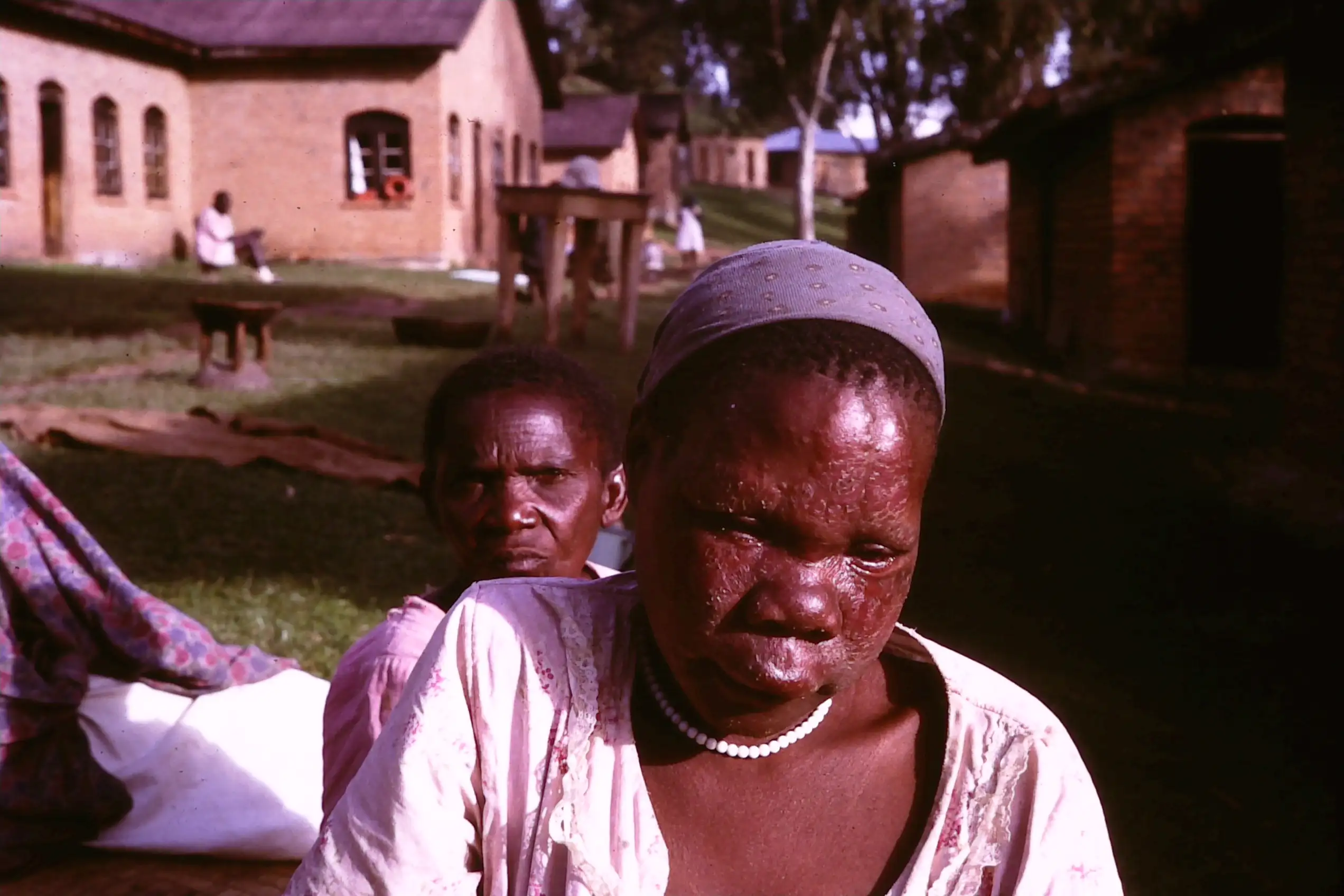 麻风病患者典型的"狮面"特征，面部皮肤增厚、结节形成