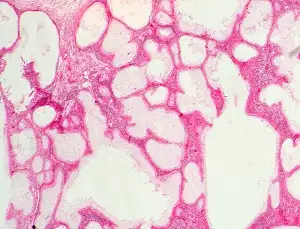 葡萄状囊尾蚴病的组织学表现