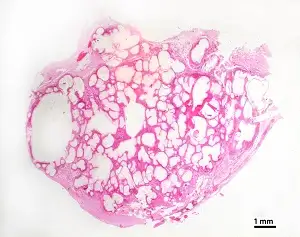 葡萄状囊尾蚴病的病理标本