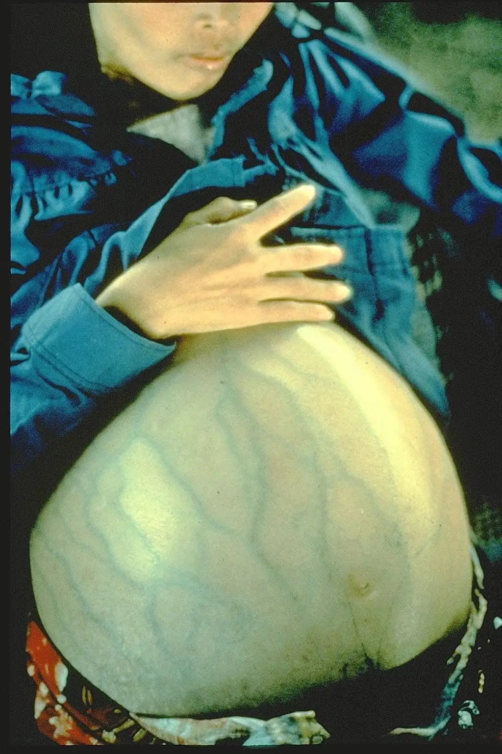 肝炎B导致的肝癌