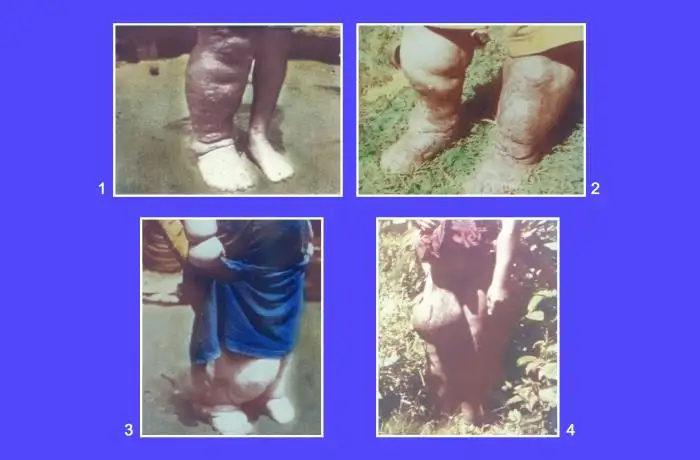 象皮病患者群体