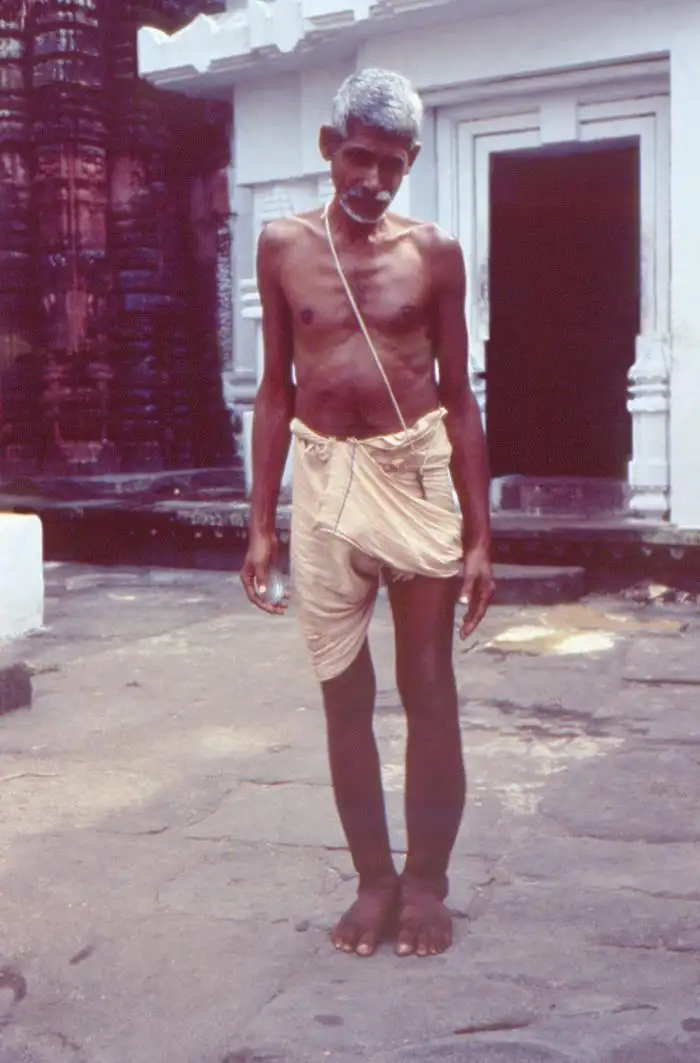 象皮病患者腿部肿胀