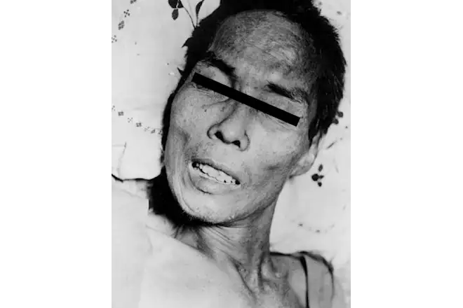 破伤风患者的苦笑面容