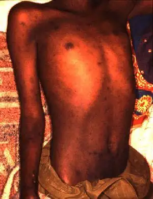 布隆迪斑疹伤寒患者