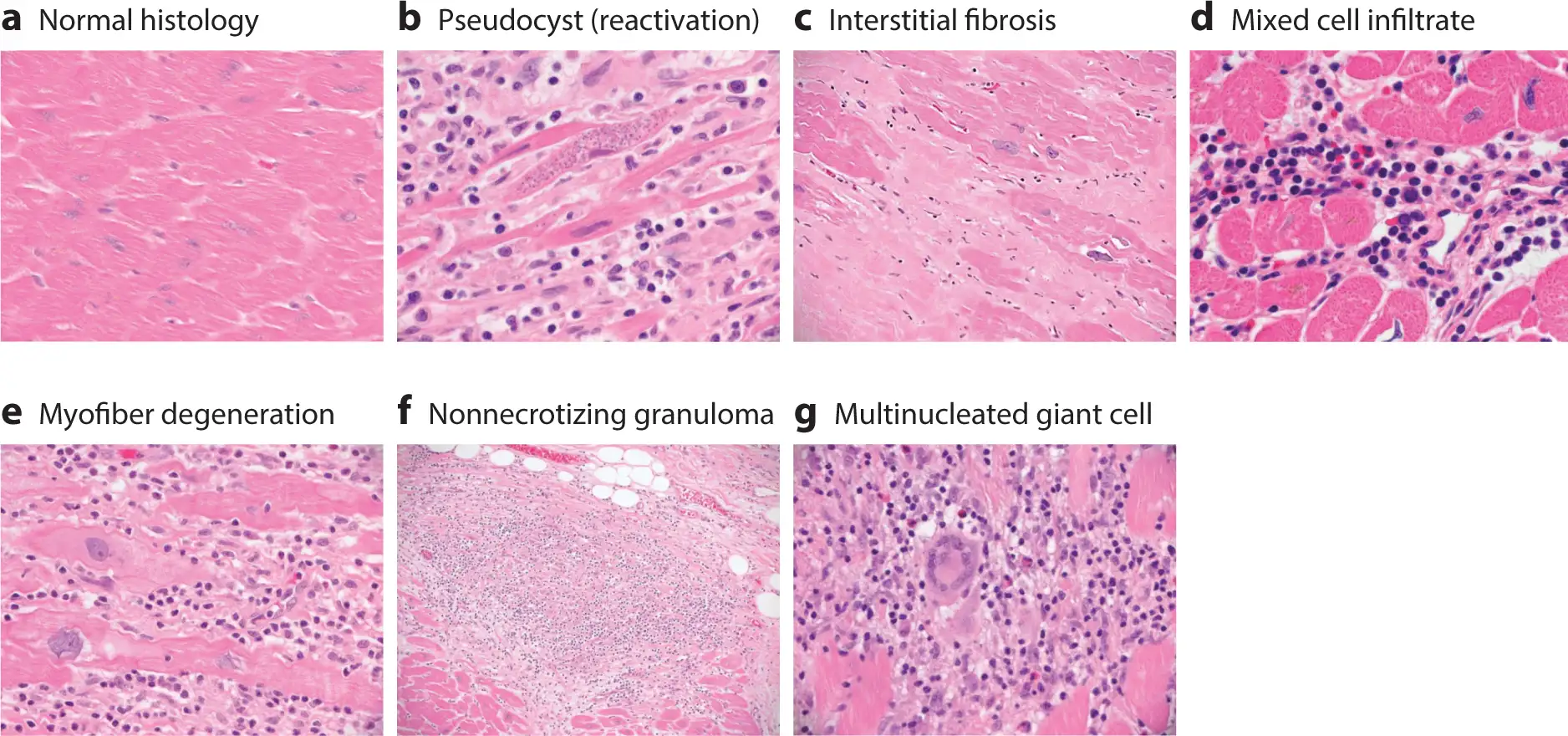 恰加斯心脏病的显微镜下病理改变