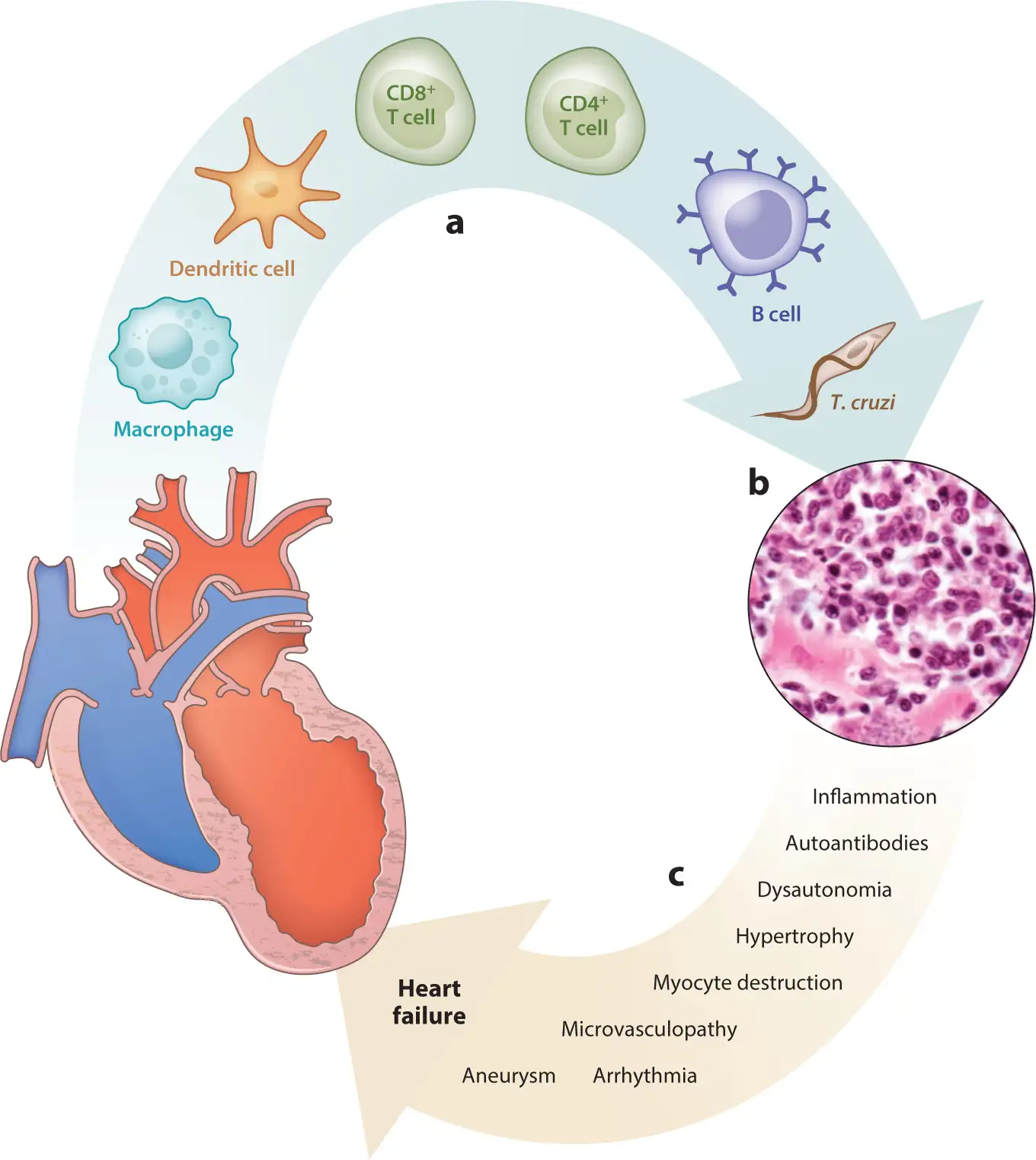 恰加斯心脏病的发病机制示意图