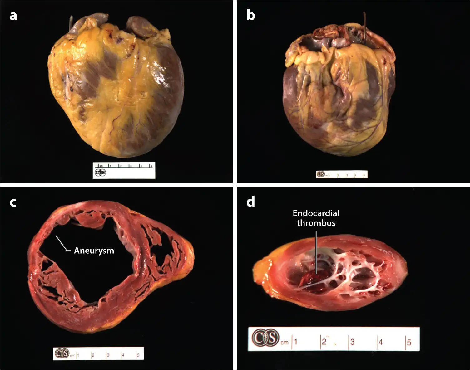 恰加斯心脏病的大体病理标本