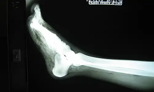 一战时期气性坏疽患者的X光照片，显示腿部肌肉中的气体条纹