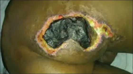 坏死性筋膜炎臀部的临床表现