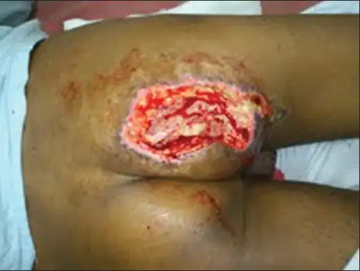 坏死性筋膜炎臀部清创后的表现