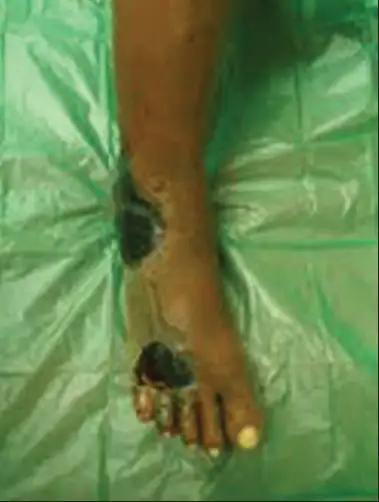 坏死性筋膜炎呈斑片状坏死的表现