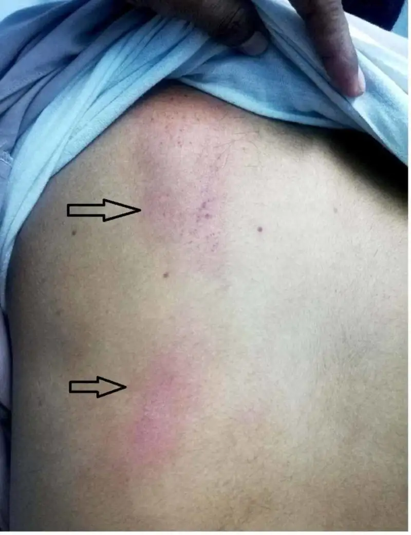 登革热出血表现：背部两处大瘀斑