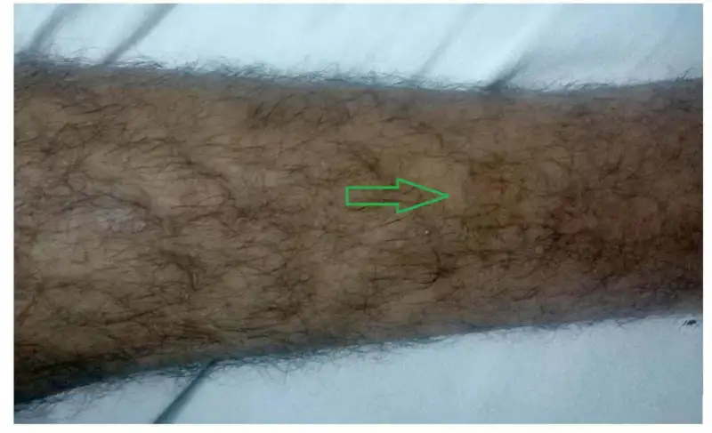 登革热出血表现：腿部多处瘀点