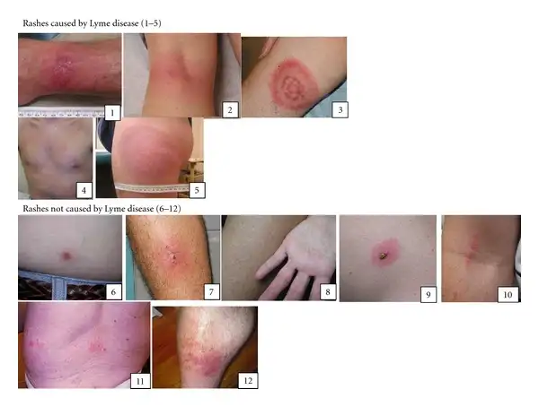 游走性红斑的多种临床表现