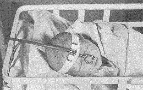 早产儿接受氧气治疗