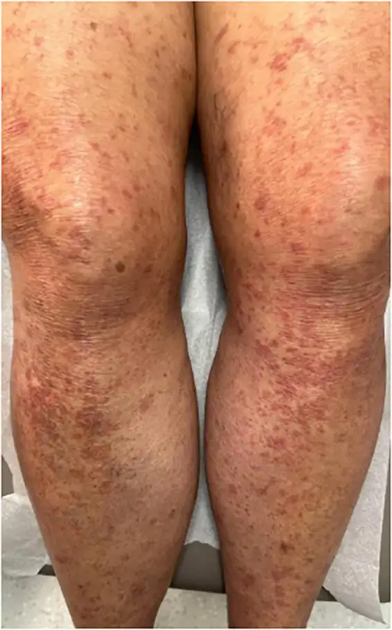ATLL皮肤病变