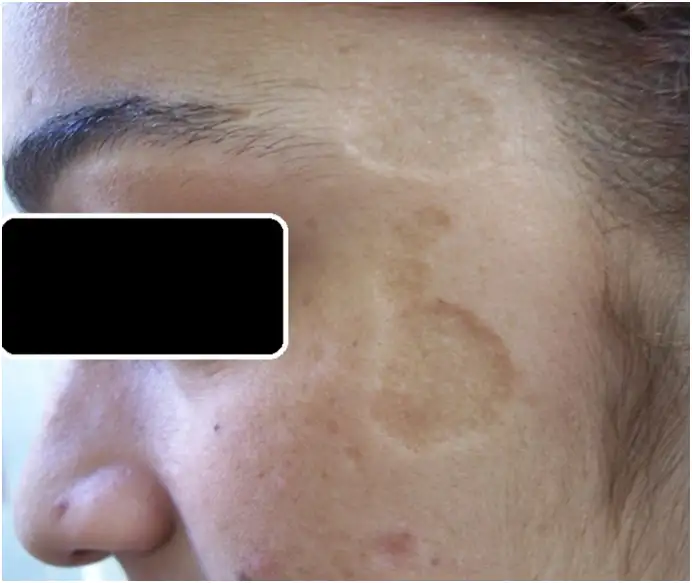 利什曼病疤痕导致的社会隔离