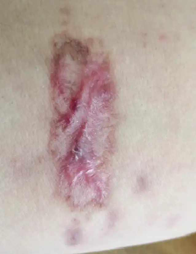 利什曼病患者治疗后的皮肤溃疡愈合情况