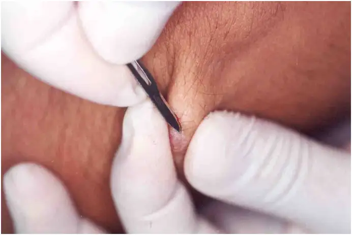 皮肤利什曼病诊断性皮肤刮片显微镜检查