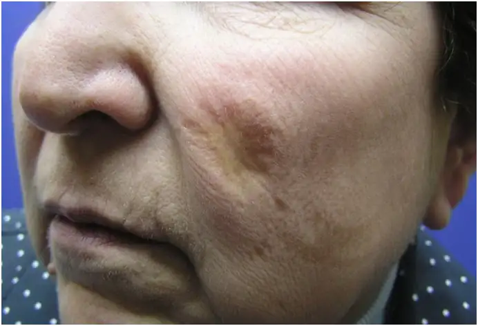 面部永久性毁容疤痕