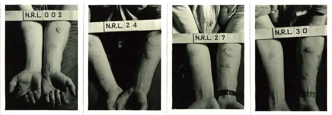 Historical photographs depict the forearms of human test subjects after being exposed to nitrogen mustard and lewisite agents in World War II experiments