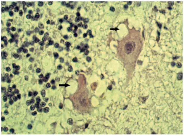 显微镜下的神经元内空泡，这是海绵状脑病的标志性病理特征