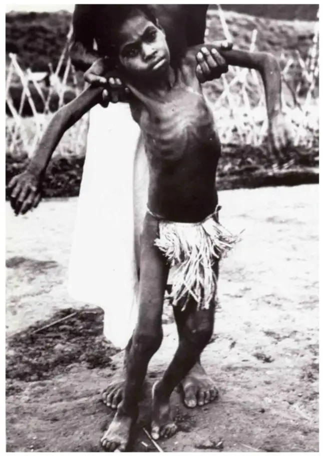 一名患有库鲁病的儿童，已无法独立站立或坐立