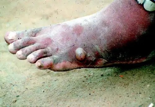 几内亚虫在脚部引起的水疱