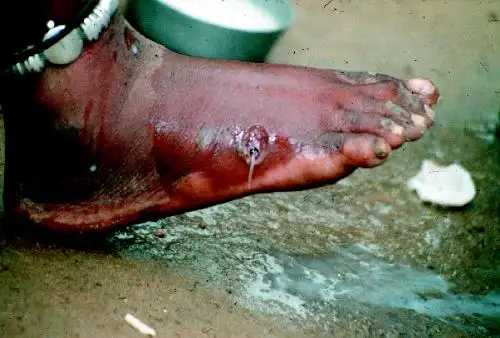 几内亚虫从患者腿部被取出的场景