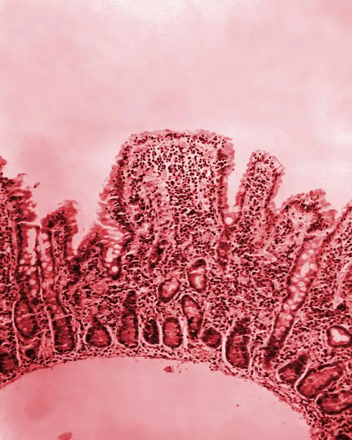 霍乱患者小肠组织